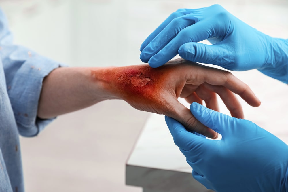 burn injury