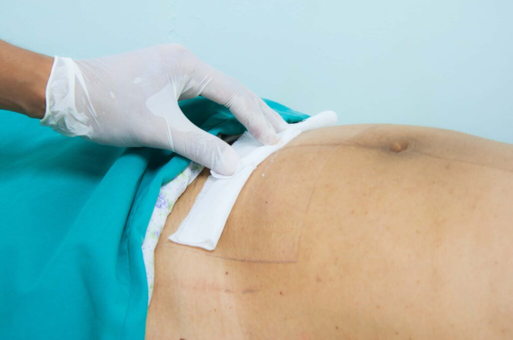 Doctor treating C-section incision with sterile bandage after childbirth surgery Doctor treating C-section incision with sterile bandage after childbirth surgery